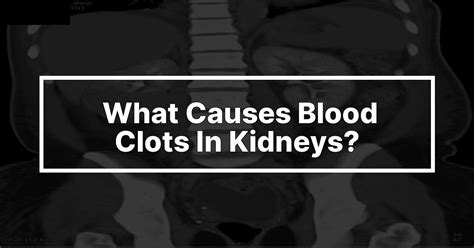 What Causes Blood Clots In The Kidneys